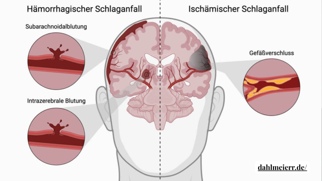 ischämischer schlaganfall