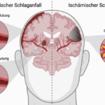 ischämischer schlaganfall